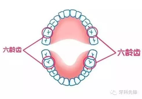 六齡牙係咩？孩子嘅六齡牙要點護理？